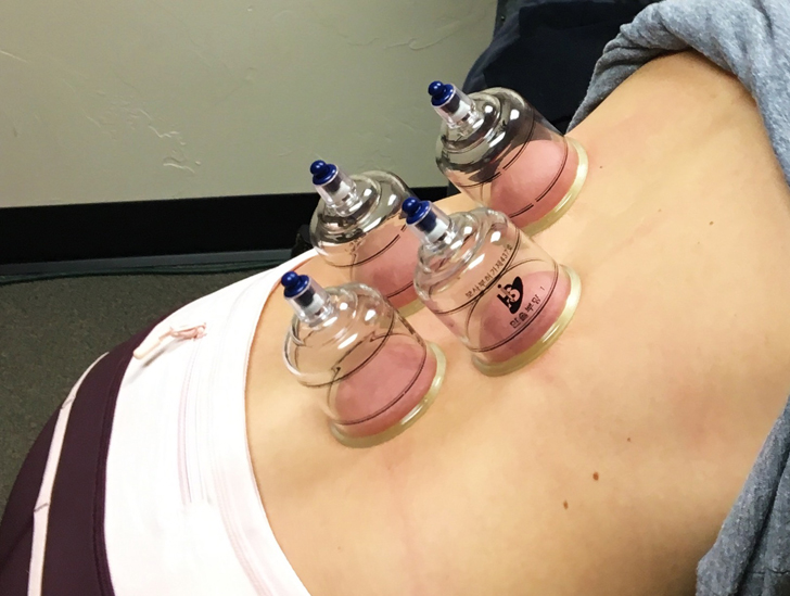 cupping3