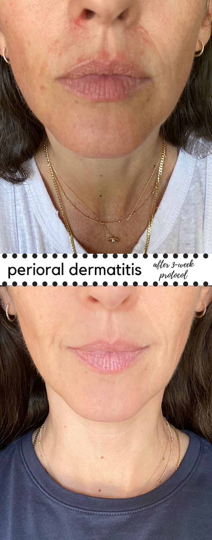 perioral dermatitis chin